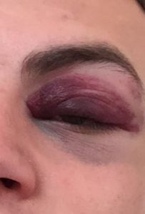 Giocatore aggredito e ferito con una testata