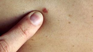 Melanoma, in crescita gli interventi nel 2023 nella Asl Tse. I consigli per la prevenzione