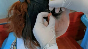 Agopuntura per pazienti affetti da paresi facciali, videoconferenza tra AOUS e Nantong Hospital
