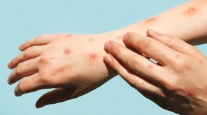 Vaiolo delle scimmie, Regione Toscana al lavoro sulla prevenzione