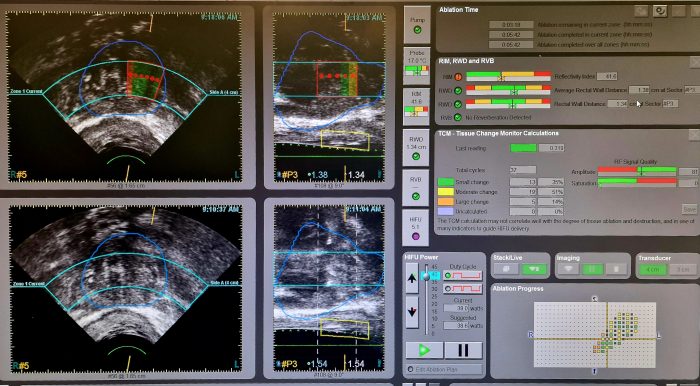 A Campostaggia eseguito un trattamento HIFU per il tumore della prostata, prima volta per l&rsquo;Asl Toscana Sud Est
