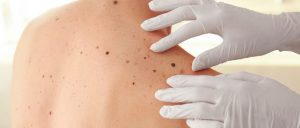 Prevenzione melanoma, diagnosi precoce e corretta protezione della pelle: l&rsquo;Aou Senese aderisce alla campagna &ldquo;Save your skin&rdquo; della SIDeMaST
