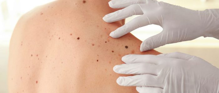 Prevenzione melanoma, diagnosi precoce e corretta protezione della pelle: l&rsquo;Aou Senese aderisce alla campagna &ldquo;Save your skin&rdquo; della SIDeMaST