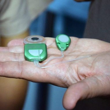 Innovazione nella cura della sordità, primo impianto cocleare totalmente impiantabile ed invisibile in Italia: interventi in contemporanea a Siena e Piacenza
